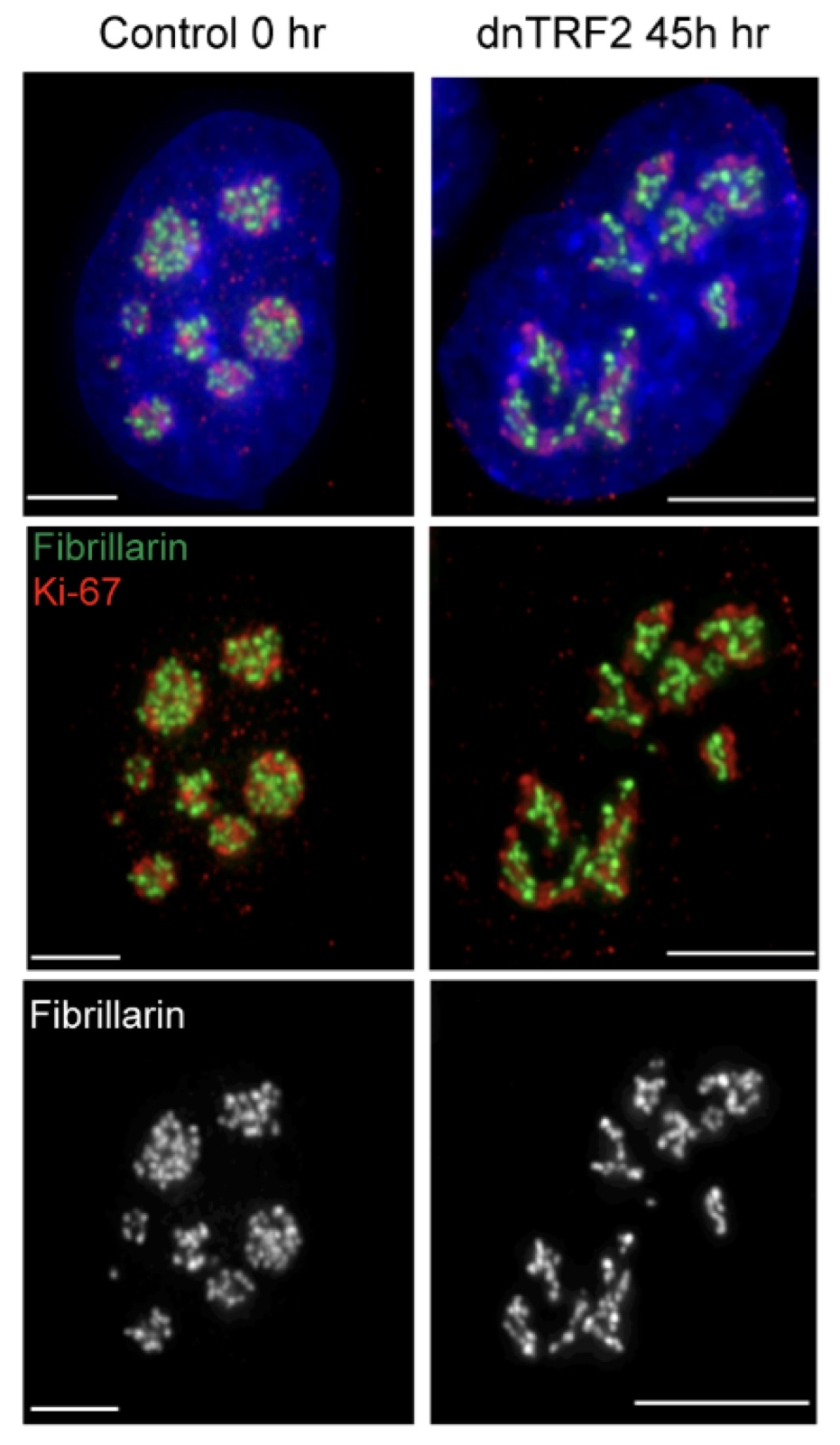 Control vs dnTRF2 nucleolar necklace